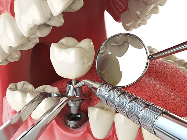 Best Urgent Care for Lost Fillings or Crowns in Rosebud, SD