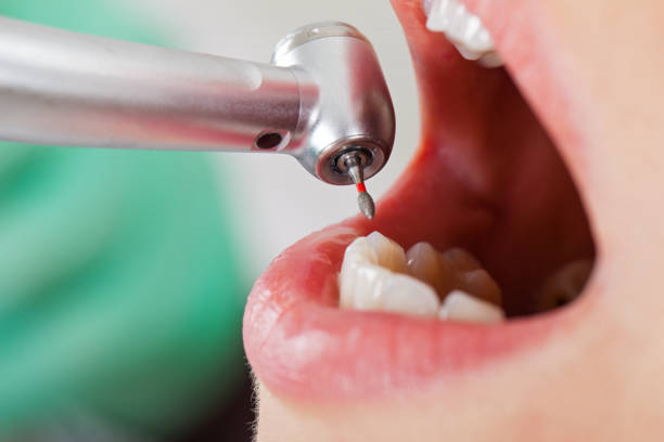 Best Emergency Gum Treatment in Rosebud, SD